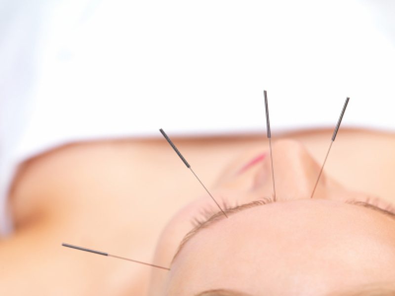 Acupuncture facial treatment